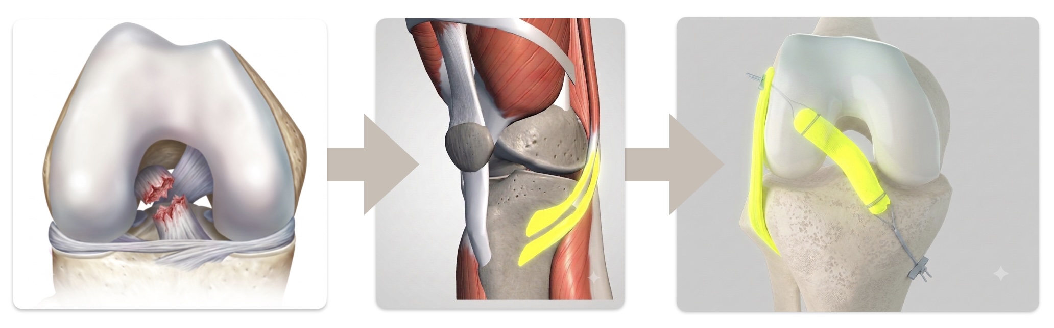 Greffe courte DT4 (système TLS) : greffe à quatre brins prélevée sur un seul tendon