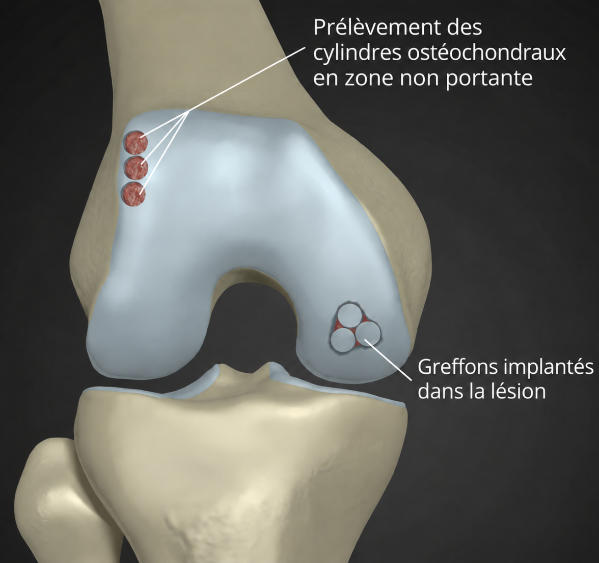 Mosaïcplastie : cylindres ostéochondraux prélevés en zone non portante et implantés dans la lésion du cartilage