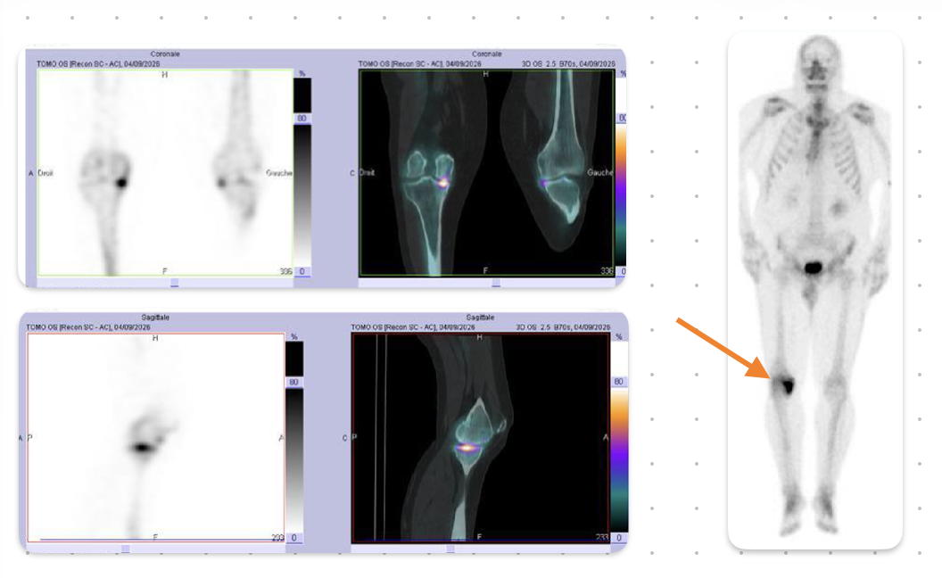 Scintigraphie osseuse du genou : hyperfixation témoignant d'une souffrance osseuse